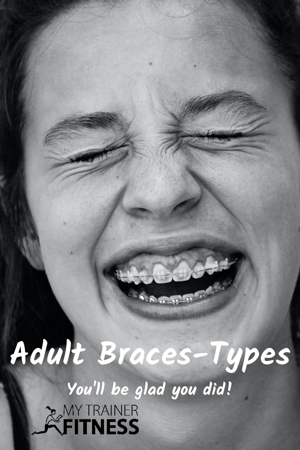 Best Braces for Adults and How to Choose My Trainer Fitness
